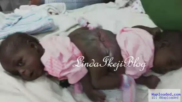 Photos: Woman Delivers Conjoined Twins In Enugu